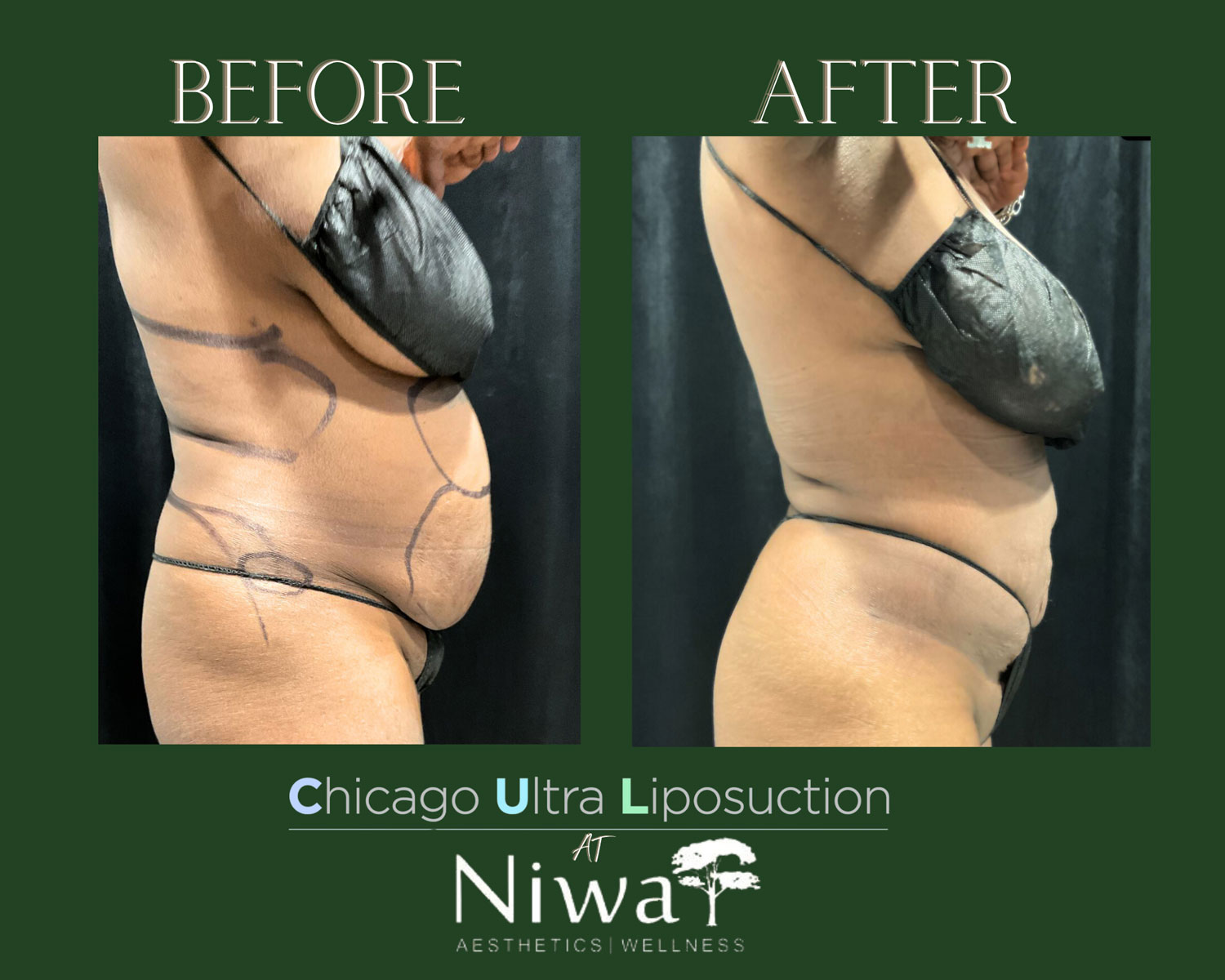 Liposuction